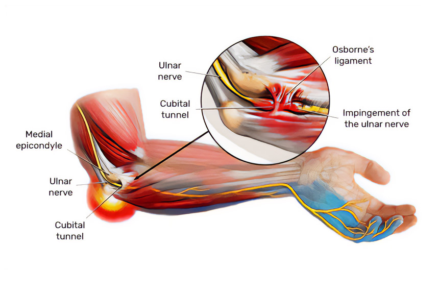 Cubital Tunnel Syndrome Treatment in Montreal