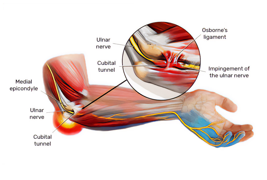 Syndrome du tunnel cubital | Hand Surgeon Montreal