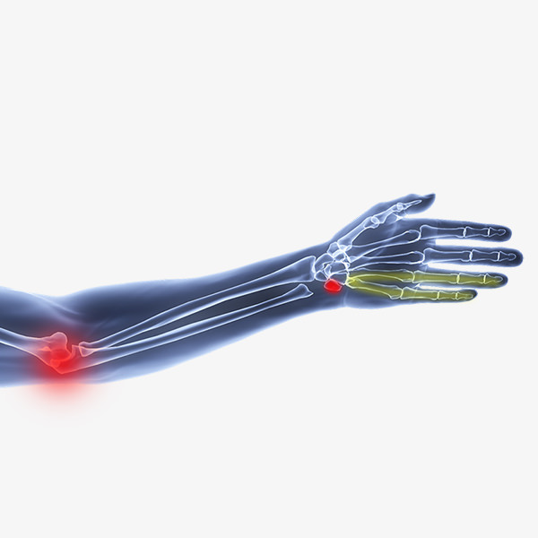 Syndrome du tunnel cubital | Hand Surgeon Montreal