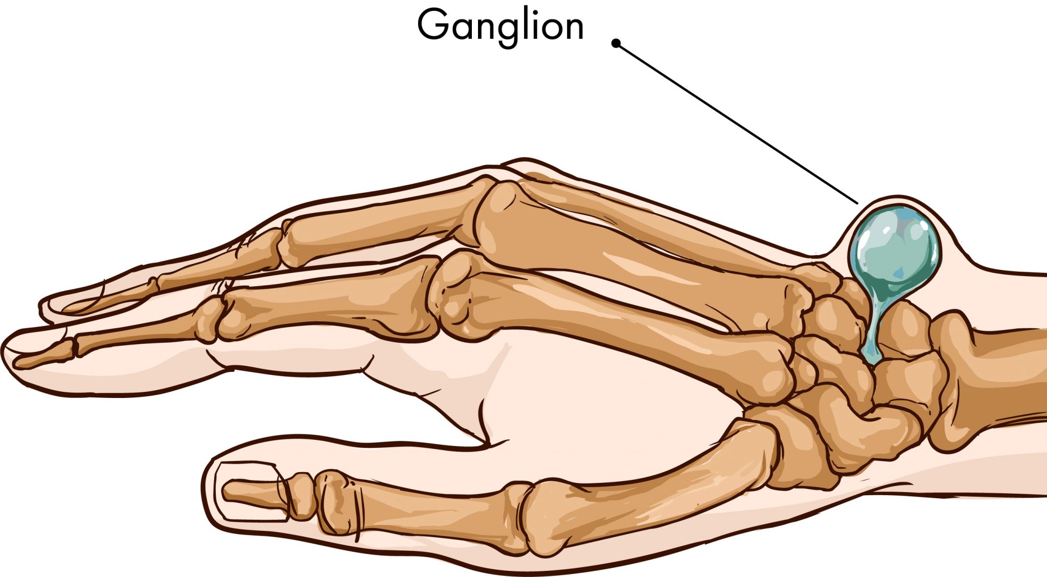Kystes ganglionnaires | Hand Surgeon Montreal