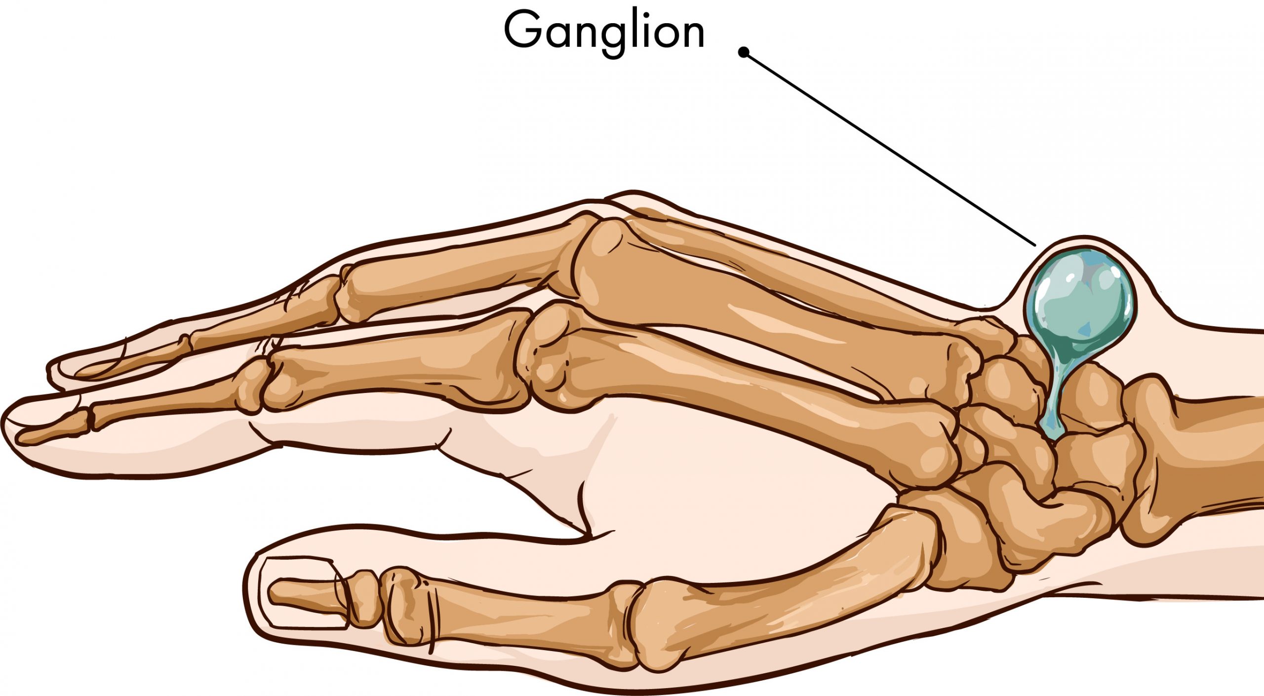 A recurred subungual glomus tumour of the thumb