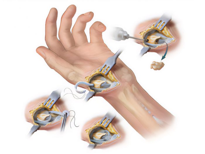 Arthroplastie articulaire du trapèze carpien du pouce Hand Surgeon