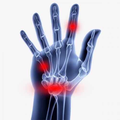 Fractures de la main, poignet et doigts | Hand Surgeon Montreal