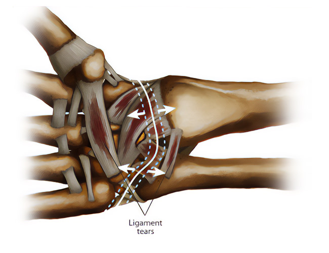 Blessures aux ligaments et tendons | Hand Surgeon Montreal