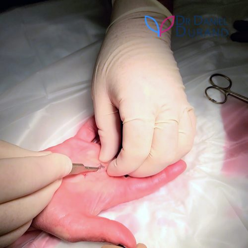 Trigger finger endoscopic treatment in Montreal by Hand Surgeon