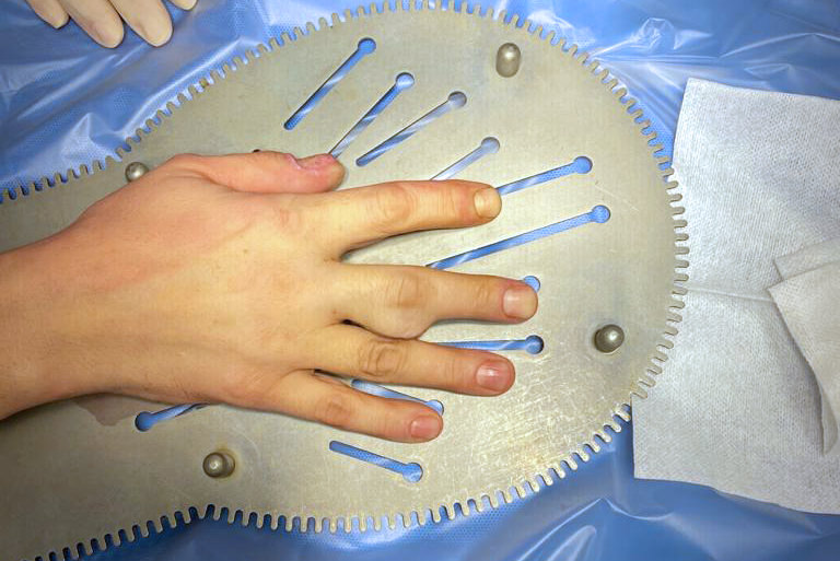 Tumeur de la main, poignet et doigts | Hand Surgeon Montreal