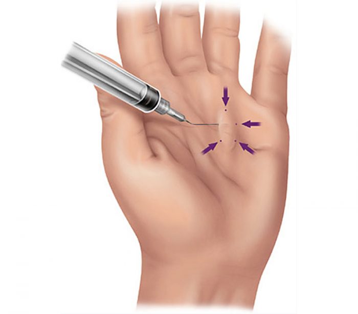 Injection Enzyme (XiaFlex®) Hand Surgeon Montreal