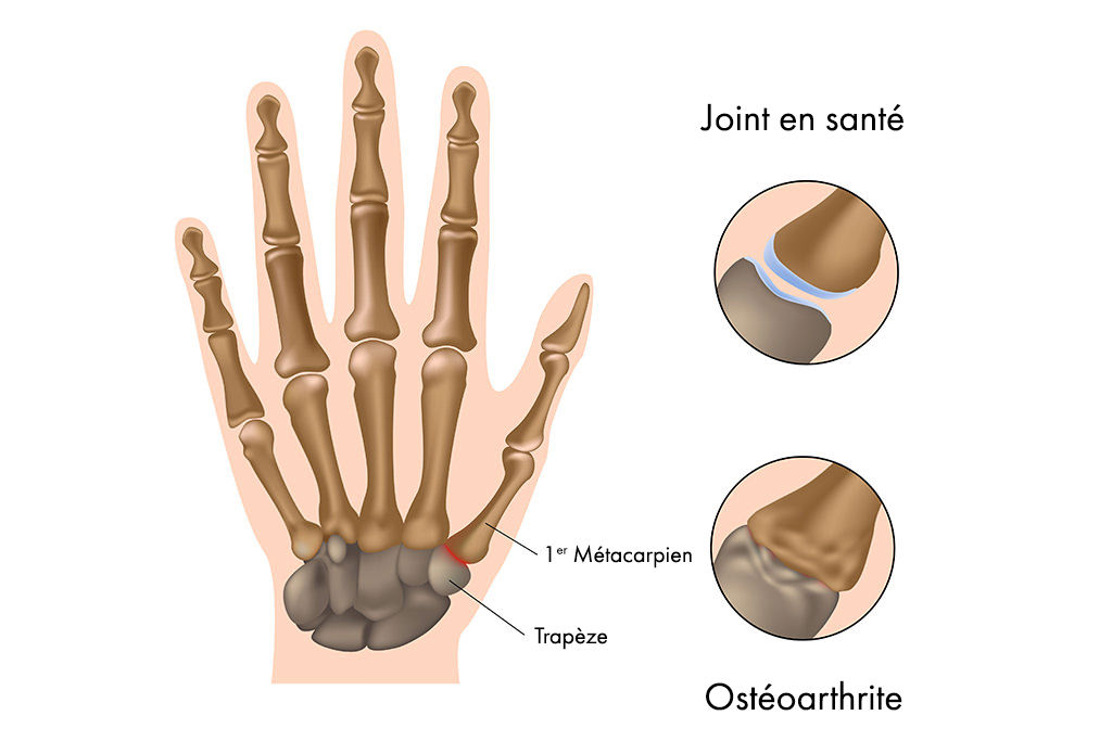Arthrite articulaire basale du pouce | Hand Surgeon Montreal