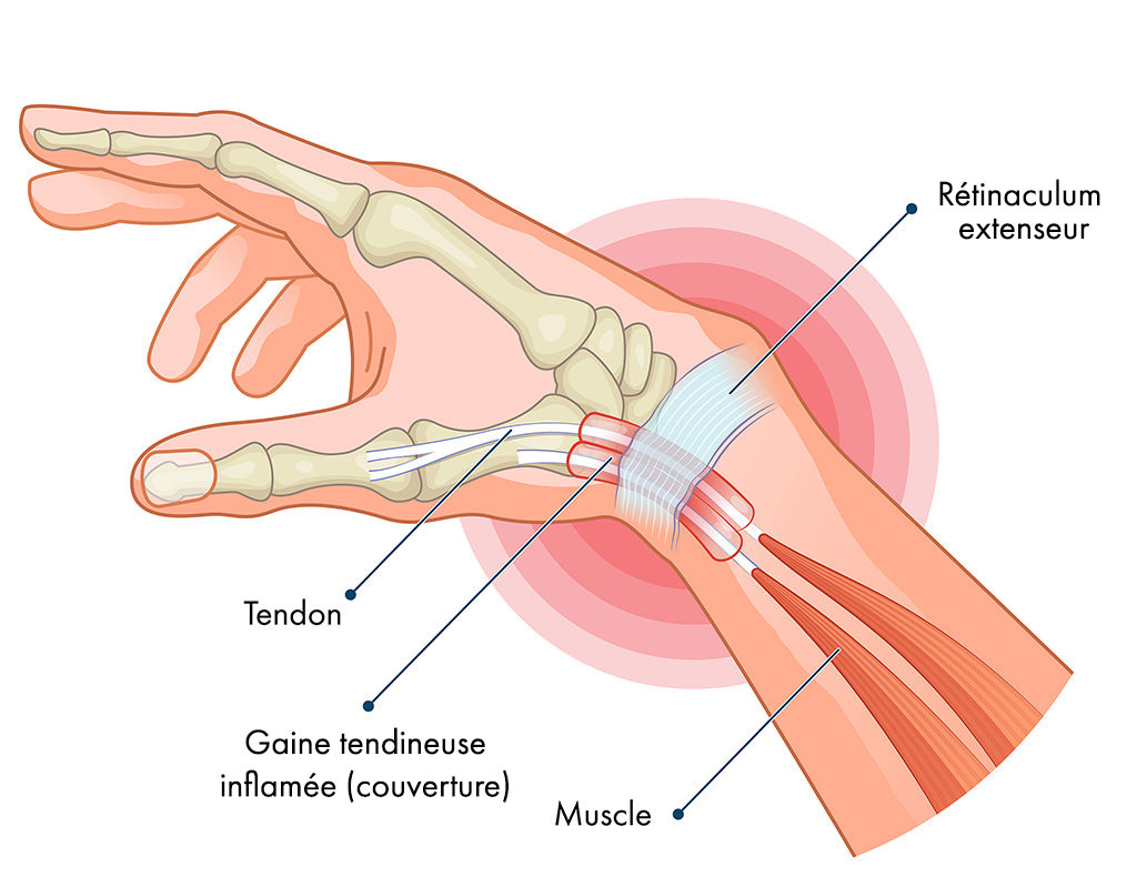 Maladie de De Quervain | Hand Surgeon Montreal