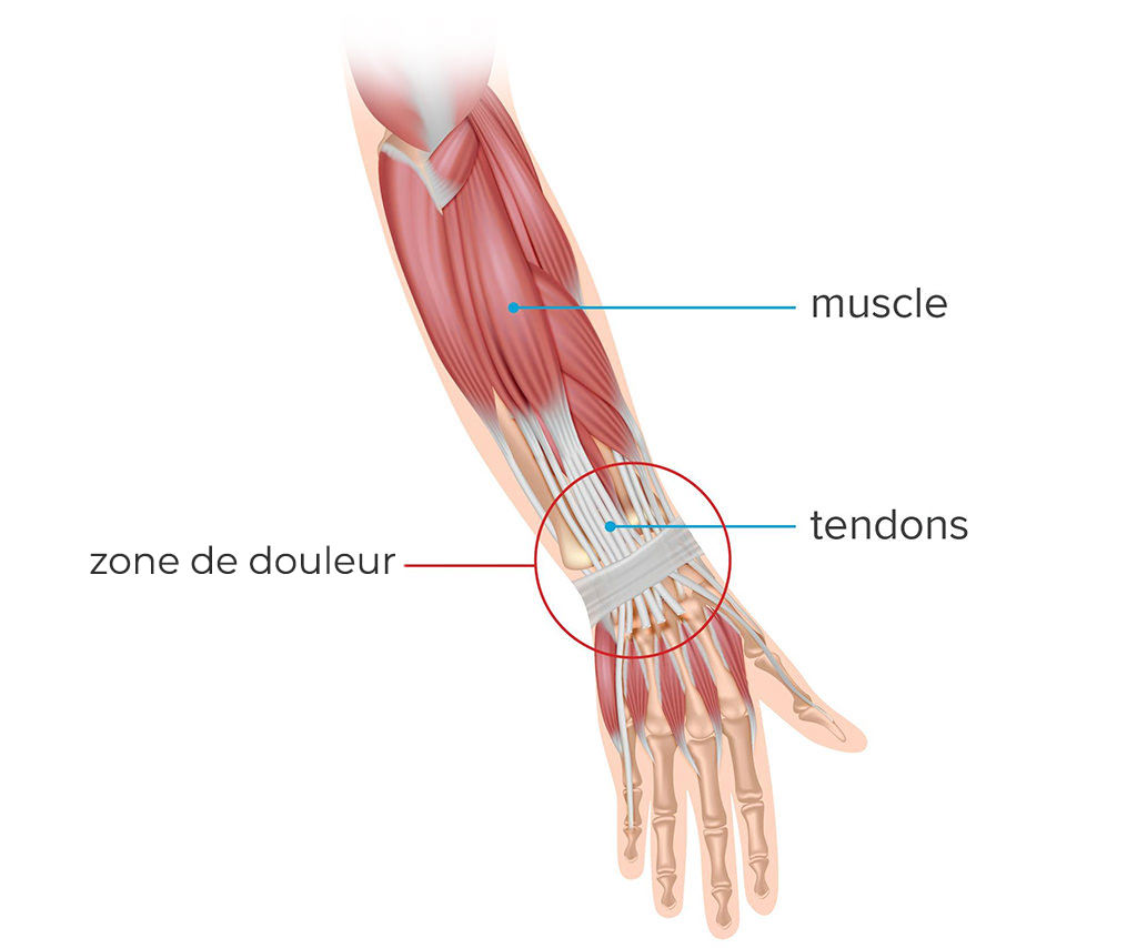 Blessures aux ligaments et tendons | Hand Surgeon Montreal